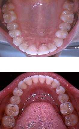 Invisalign after 109380