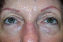 Prevelle Silk Under the Eyes before 144290