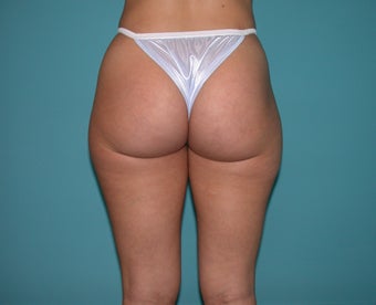 Liposuction of flanks and outer thighs before 255683