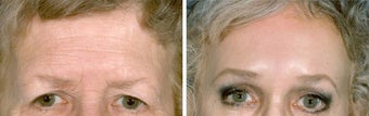 Forehead Lift before 652145