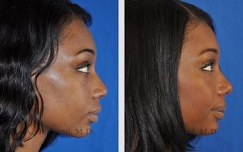 African American Ethnic Rhinoplasty after 487997