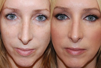 Lower eyelid rejuvenation with Silikon-1000 before 228583