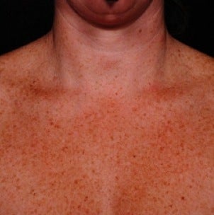 IPL for Chest before 374389