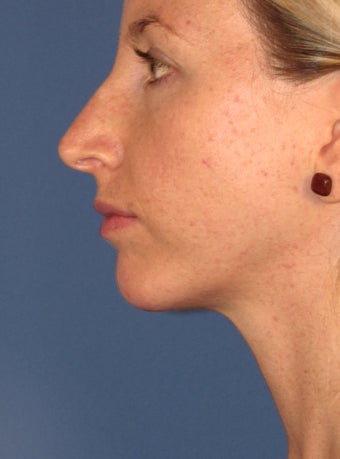 Chin Implant 414149