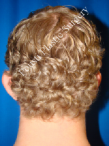 Ear Surgery (Otoplasty) 584563