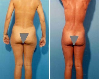 Liposuction before 636115
