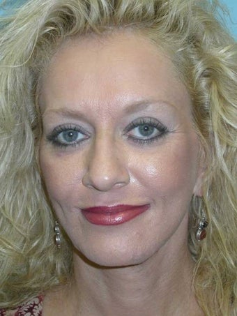Full Facial Rejuvenation after 148582