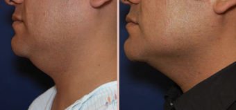 Jawline / Neck Lipo before 293426