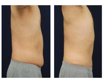 Abdominoplasty - Tummy Tuck 396153