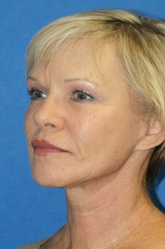 Facelift, Fat Transfer, and Skin Pinch 398946