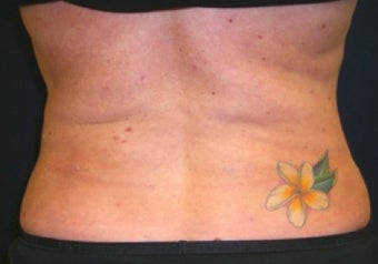 Lipo for back after 374829