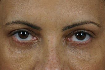 Restylane after 309257