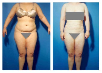 Liposuction before 636296