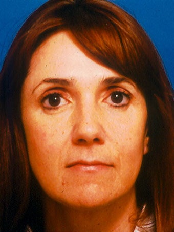 Cheeklift (Minifacelift), Lateral Temporal Browlift, Bilateral Lower Blepahroplasty. before 249148
