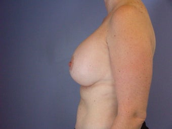 Circumareolar Breast Lift with Breast Implants after 309739