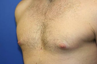 Smart-Lipo of the Chest, Liposuction, Gynecomastia 402440