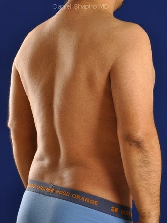 Vaser Hi Def Liposuction of chest, abdomen, back and flanks 422695