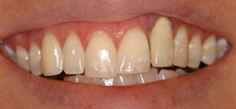 Invisalign, whitening, porcelain veneers and porcelain bridge before 119961