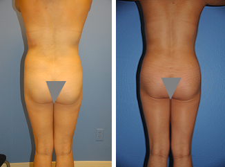 Buttocks Enhancement before 298395