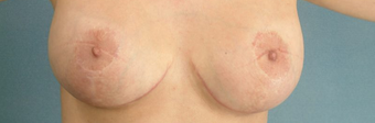 Areola Reduction and Breast Augmentation after 100248