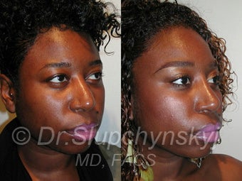 African American Rhinoplasty before 374061