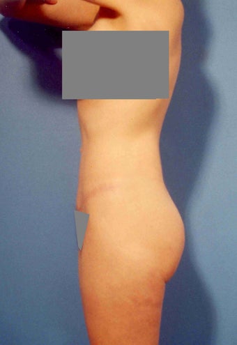 Abdominoplasty after 356332