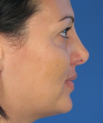 Revision Rhinoplasty 410783