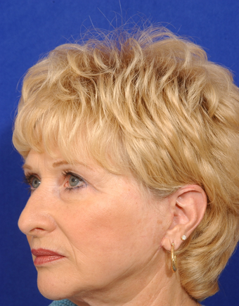 Upper blepharoplsty with cheeklift, facelift after 279314