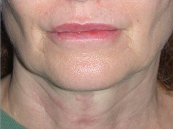 Necklift after 208447