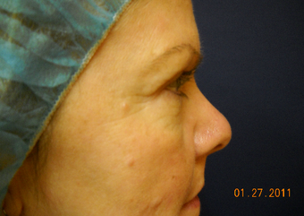 Mole Removal before 622174
