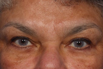 Radiesse and Dysport to Glabella after 308305