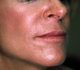 Correction of Facial Aging Grooves after 157594