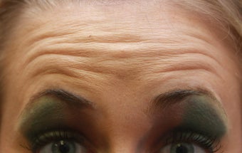 Botox before 398398