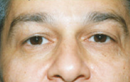 blepahroplasty before 476583