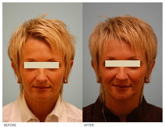 Injectable Fillers (Restylane/Perlane) before 136776