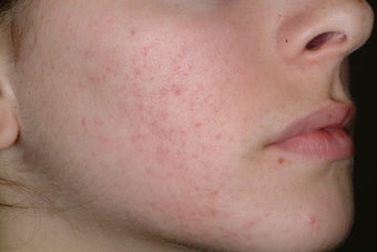 Acne and Isolaz after 95914