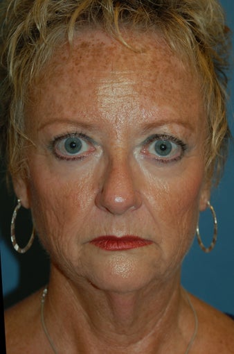 Co2 Laser Skin Resurfacing before 269711