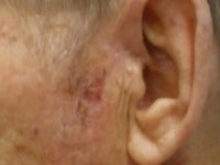 Basal Cell Carcinomas Excisions before 272097