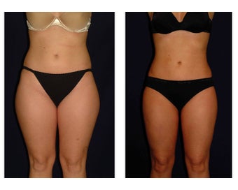 Liposuction before 286632