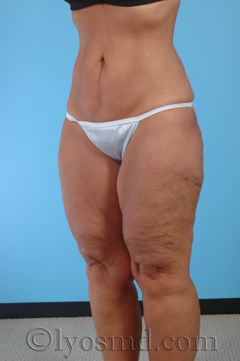 Lower Body Lift, Inner Thigh Lift before 255918