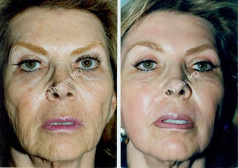 Non-Surgical Face Lift- Exoderm before 242976