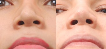 Revision Rhinoplasty after 468268