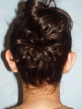 Ear Surgery (Otoplasty) 357655