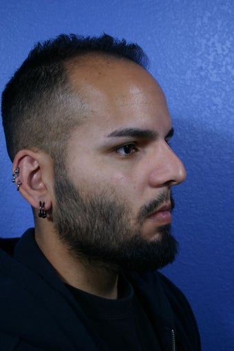 Revision Rhinoplasty before 418919