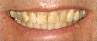 Porcelain Veneers before 112067