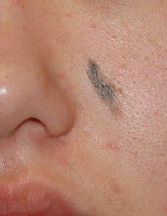Lesion Removal, Excision before 134447