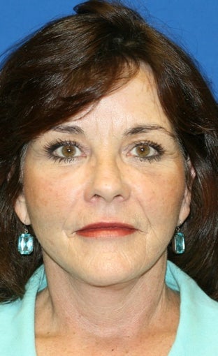 1 month pot-op: Facelift, Necklift, Neck Liposuction, Fat Transfer, and Browlift 424191