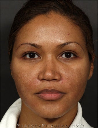 Sculptra & eMatrix before 319350