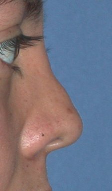 Rhinoplasty - Surgical Revision before 98855