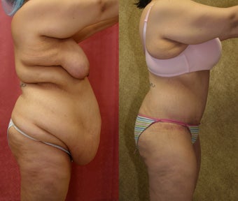tummy tuck 304693